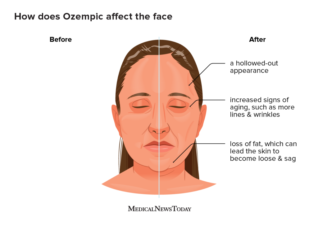 Diagram illustrating Ozempic Face, showing facial volume loss and potential treatment areas addressed by Lip Doctor in Mississauga and Oakville.