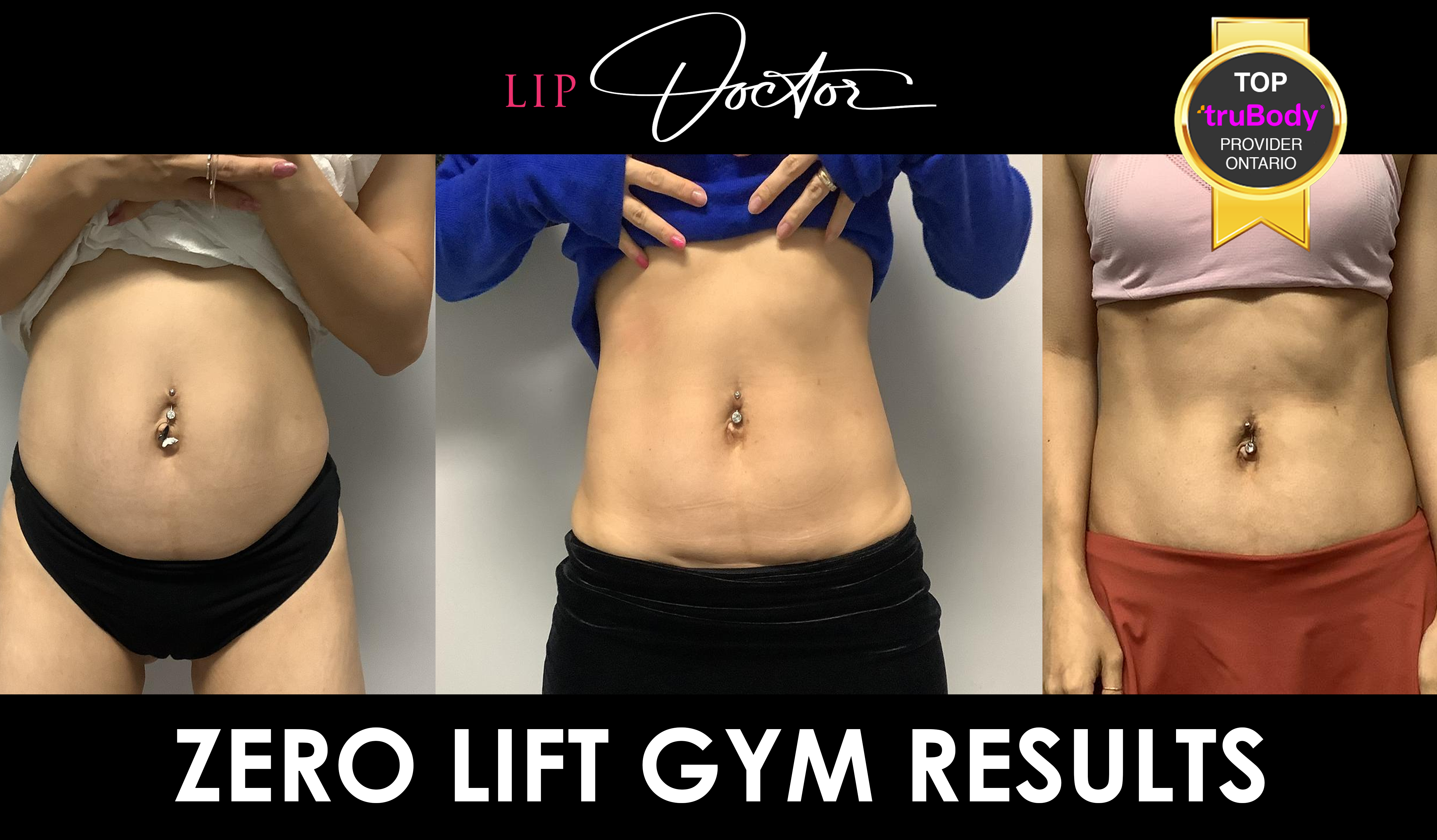 Dramatic Zero Lift transformation before and after, showcasing the combined power of TruFlex, TruSculpt, and Morpheus8 for a sculpted, toned body at Lip Doctor.