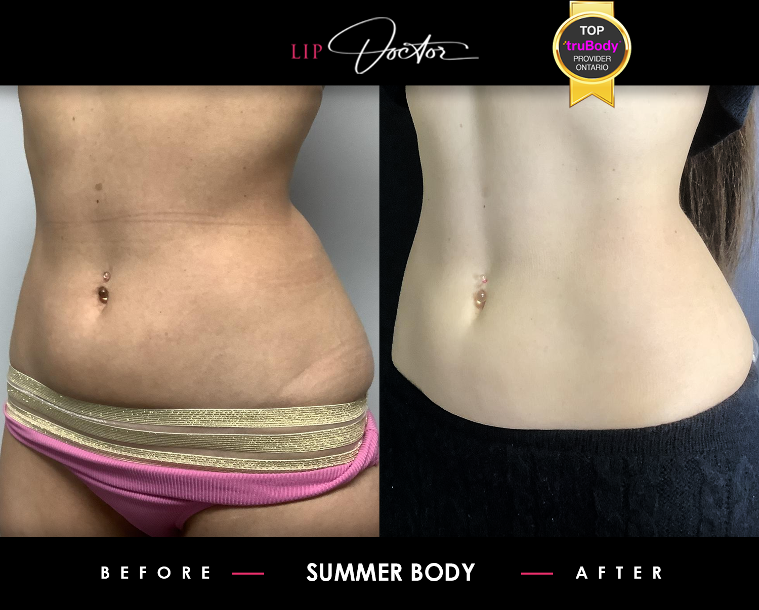 Before and after images showcasing significant belly fat reduction and enhanced muscle definition from TruBody treatments at Lip Doctor in Mississauga and Oakville.