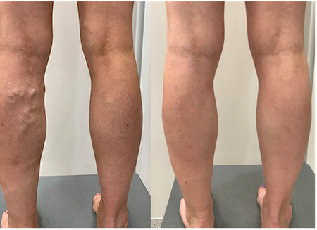 Sclerotherapy results mississauga oakville 1
