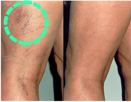 Sclerotherapy results mississauga oakville 2