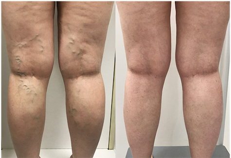 Sclerotherapy results mississauga oakville 3