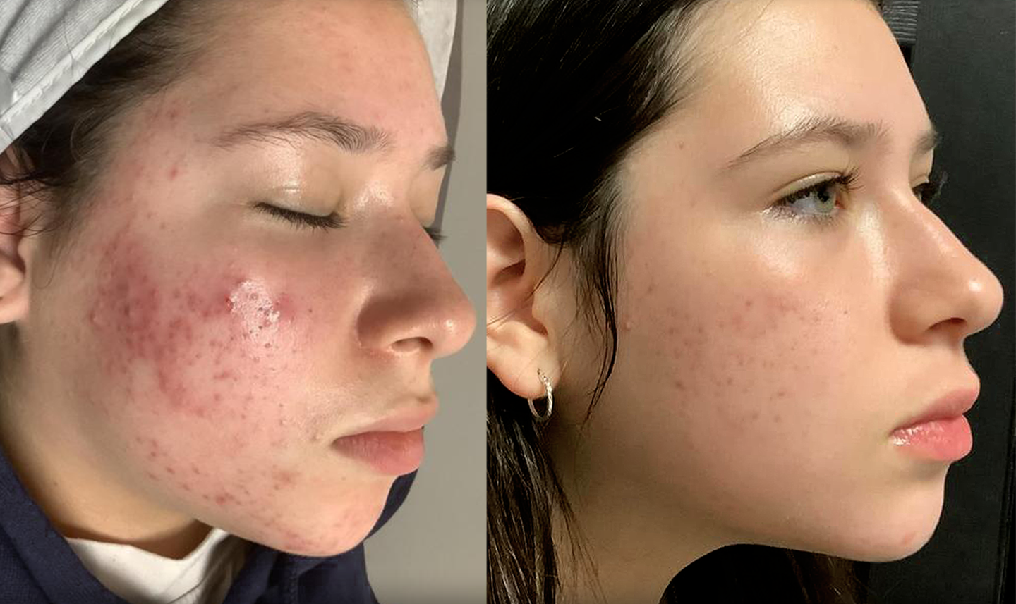 Impressive before and after results from acne treatment, showcasing clear, smooth skin after professional care in Mississauga and Oakville