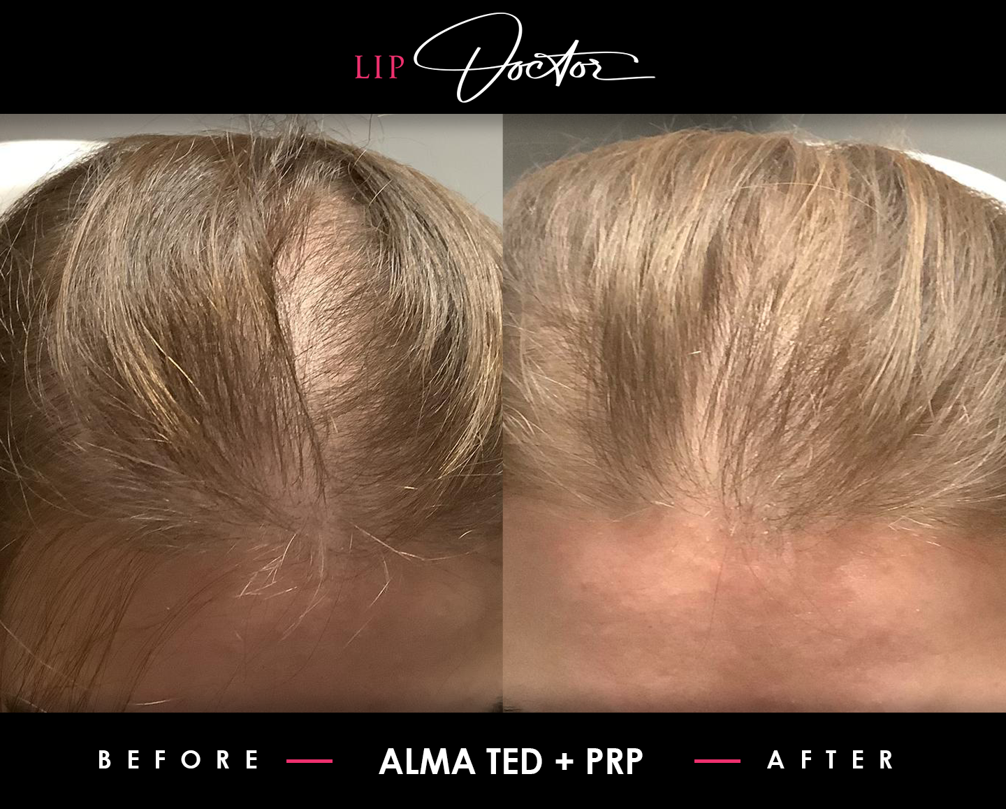 Before and after photo showing the effectiveness of PRP therapy for hair restoration by The Lip Doctor.