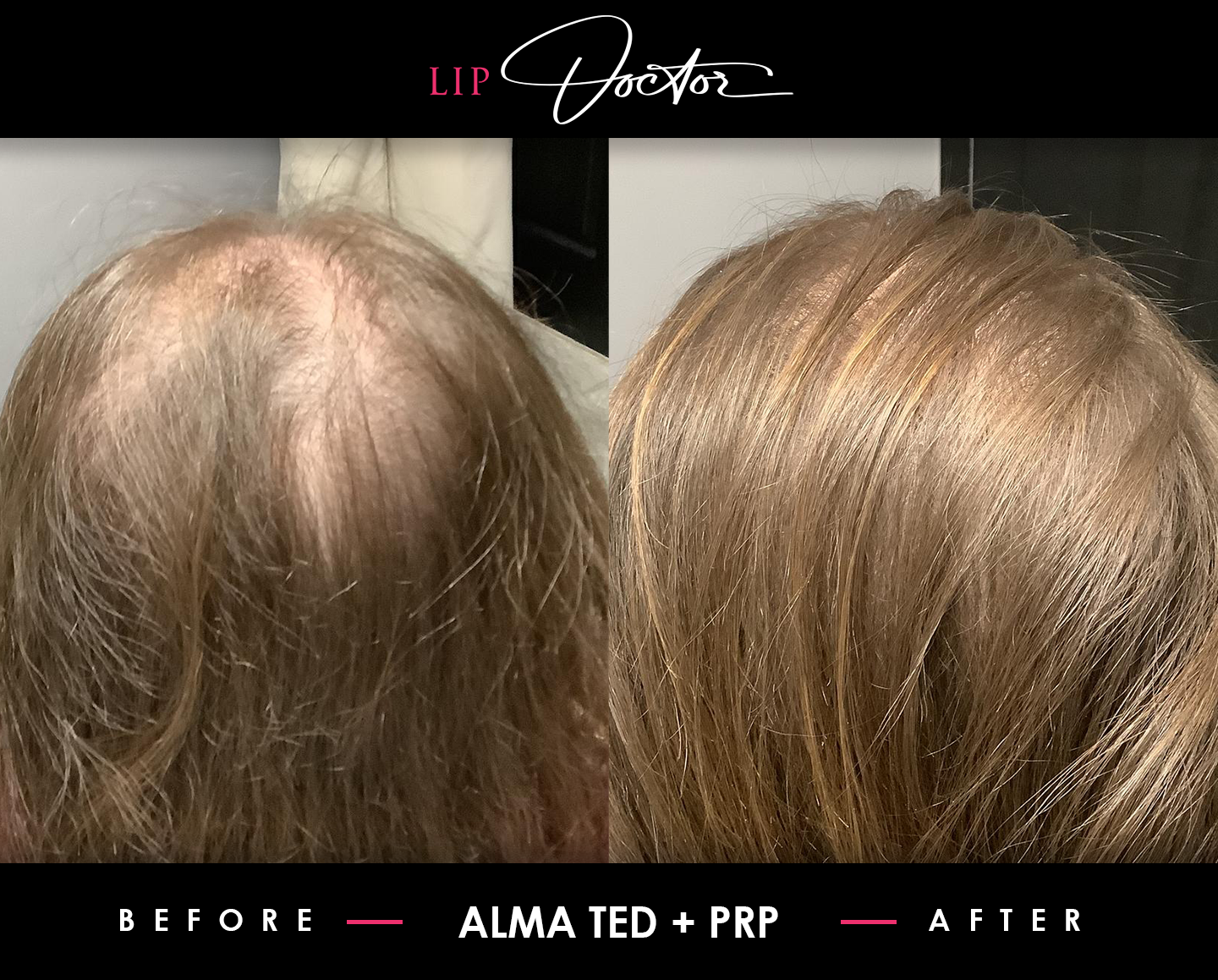 Dramatic improvement in hair density after PRP treatment at The Lip Doctor, visible in before and after images.