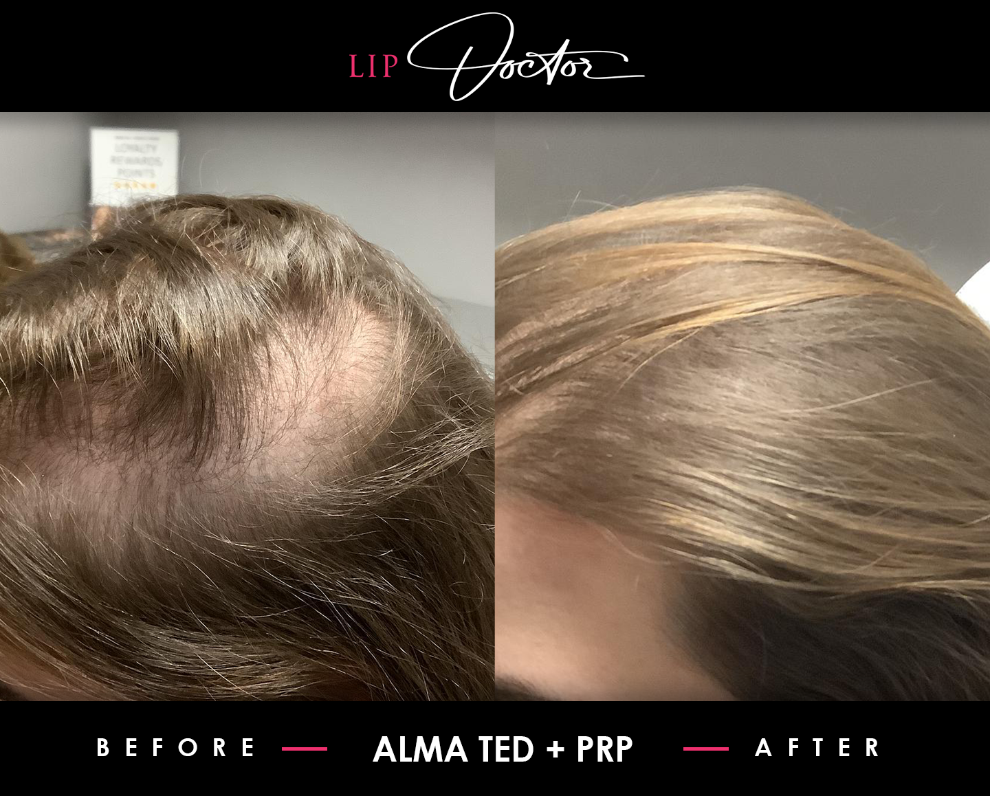 Transformative hair recovery with PRP therapy at The Lip Doctor, depicted in before and after photos
