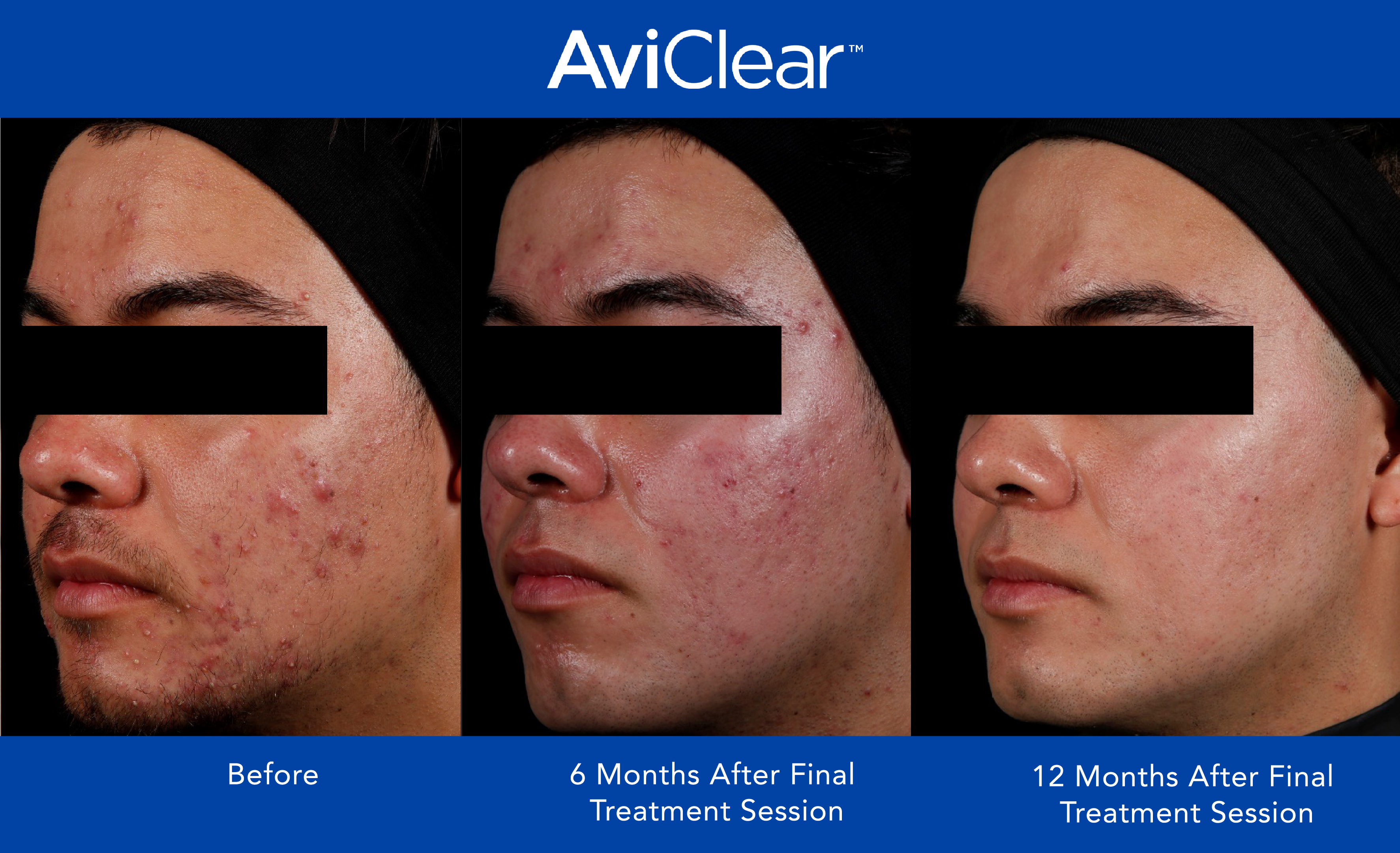Before Photos of Skin Prior to AviClear Acne Treatment Transformation 