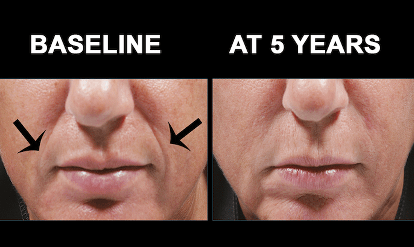 Results of a Bellafill treatment at Lip Doctor in Mississauga, highlighting the reduction of nasolabial folds and a more rejuvenated, youthful appearance