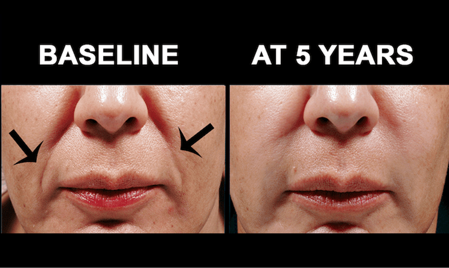 Before and after images of Bellafill treatment, showing reduced acne scarring and smoother skin with long-lasting results.