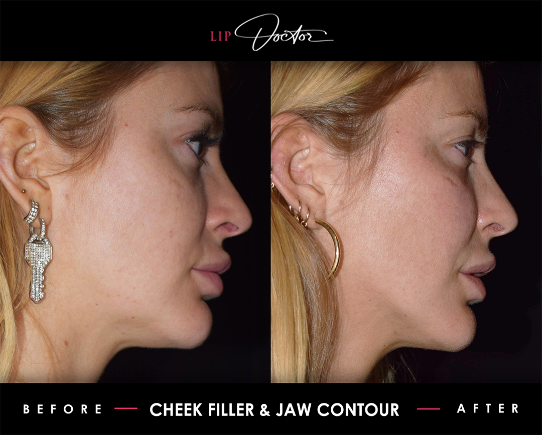 Before and after image showing the enhanced jawline and fuller cheeks achieved through dermal fillers at Lip Doctor, providing a more defined and youthful facial contour.