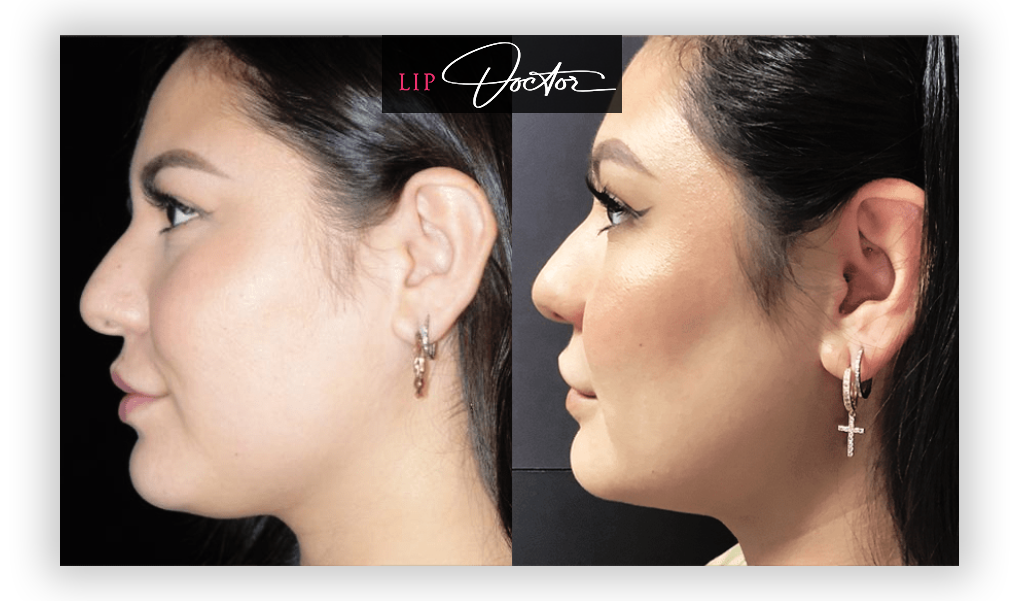 Before and after photos of double chin reduction using Kybella at Lip Doctor in Mississauga and Oakville, showcasing significant jawline contouring and enhancement.