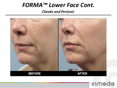  Before and after image of the 48 Hour Glow Up Forma treatment showcasing immediate skin tightening, improved texture, and a youthful glow for special events