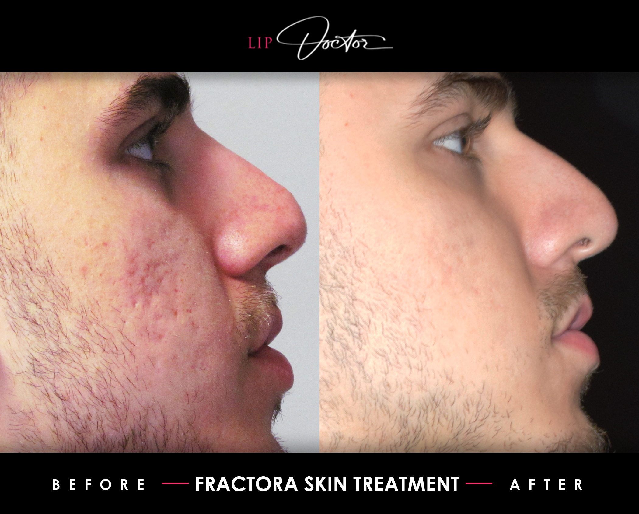 Second set of before and after photos illustrating the transformative effects of Fractora treatment at Lip Doctor. The 'Before' photo reveals deep acne scars and a rough skin surface, while the 'After' photo demonstrates a remarkable transition to a smoother, more even, and revitalized complexion, emphasizing Fractora's powerful impact on skin restoration.