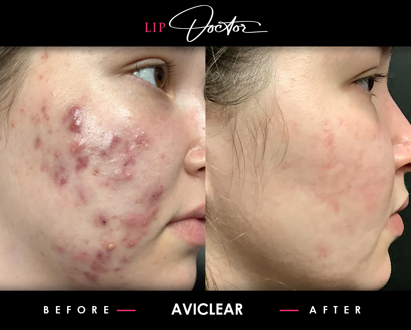 Before and after photo of a woman showing remarkable improvement in acne clearance following a successful AviClear treatment.