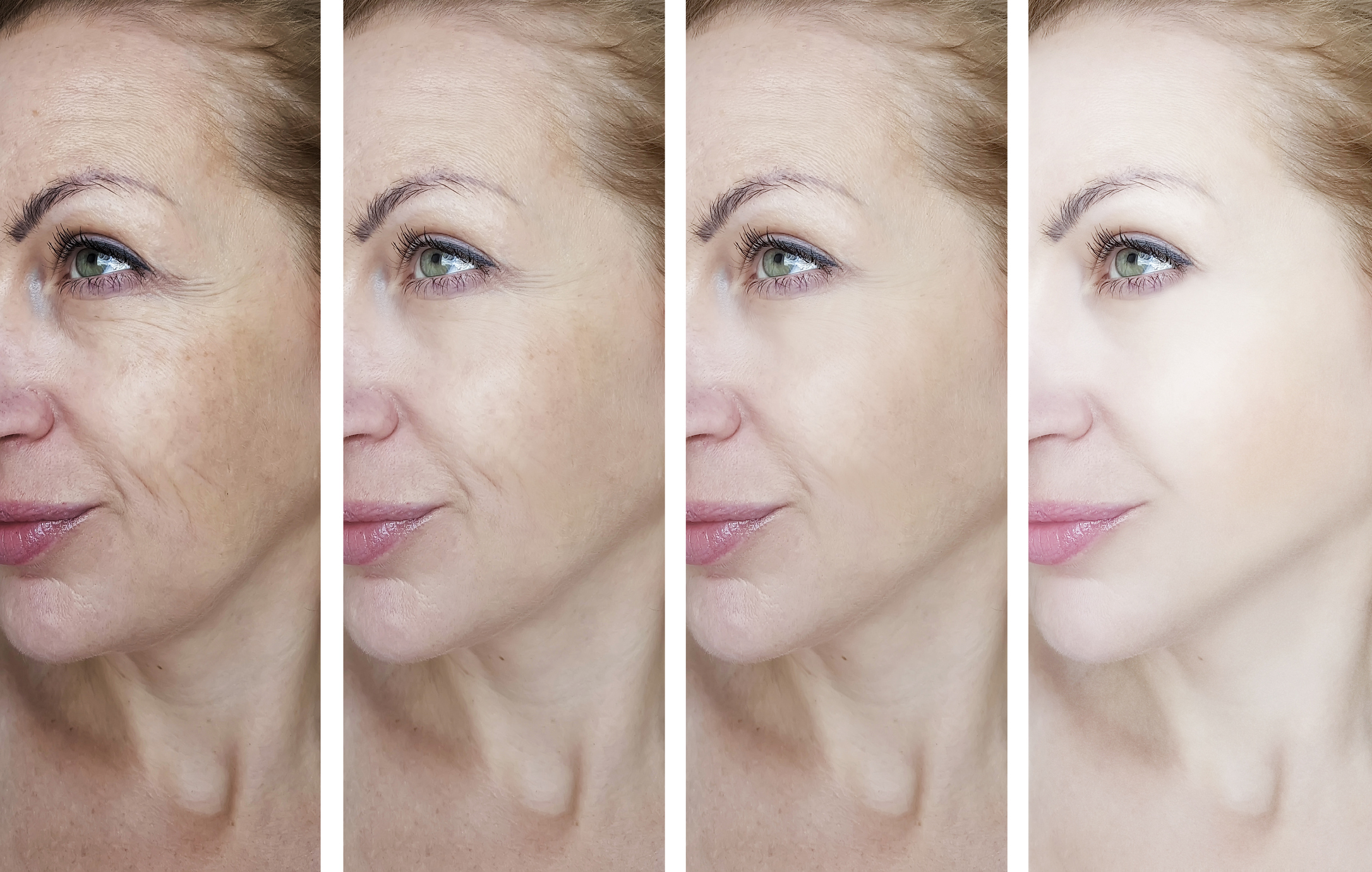 Advanced skin rejuvenation procedures at Lip Doctor, showcasing a glowing, healthy complexion post-treatment, highlighting effective results in Mississauga and Oakville.