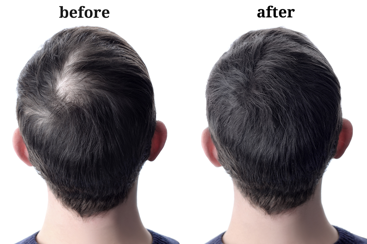 A man experiencing hair loss treatment to promote fuller hair growth.