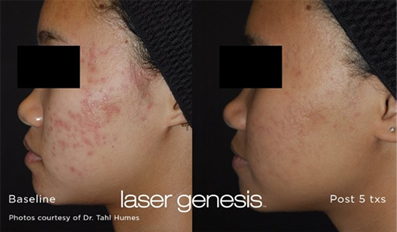 Before and after image of the Hollywood Facial featuring Laser Genesis, showing reduced fine lines, minimized pores, and improved skin texture for a youthful, radiant appearance 