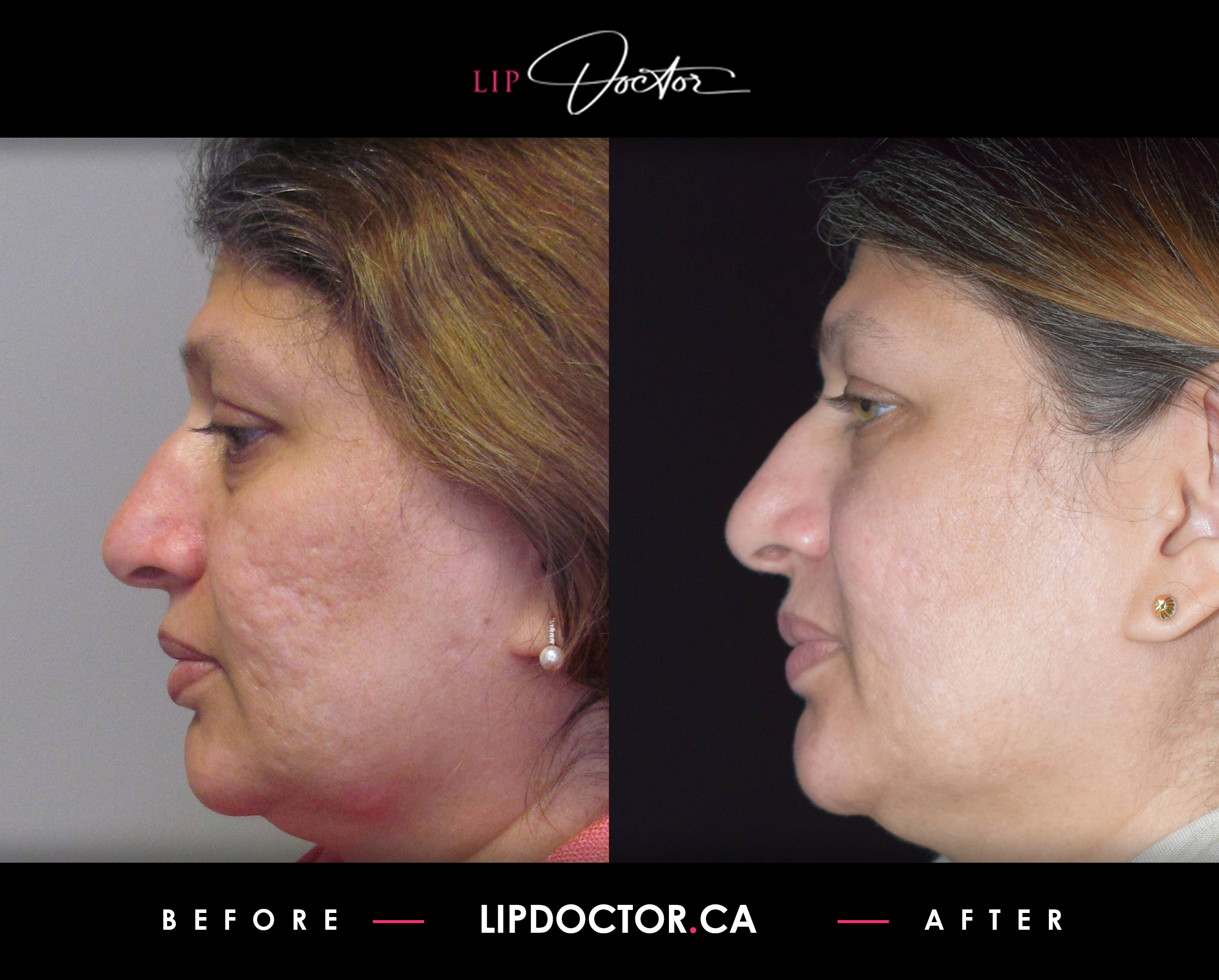 Before and after images of a successful Fractora treatment by Lip Doctor. The 'Before' image displays noticeable acne scarring and uneven skin texture, while the 'After' image showcases significant improvement with smoother, clearer, and rejuvenated skin, highlighting the effectiveness of Fractora in treating skin conditions.