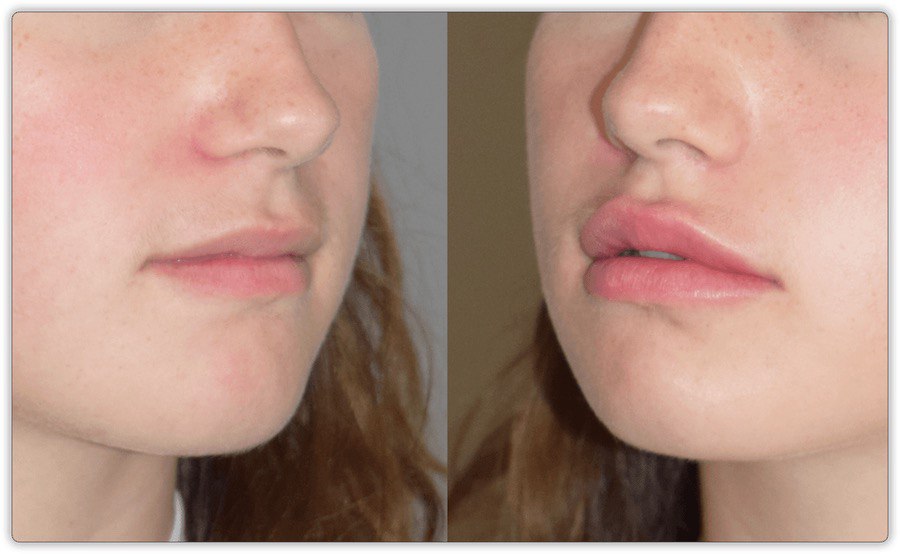 lip filler before after lip doctor mississauga oakville 4