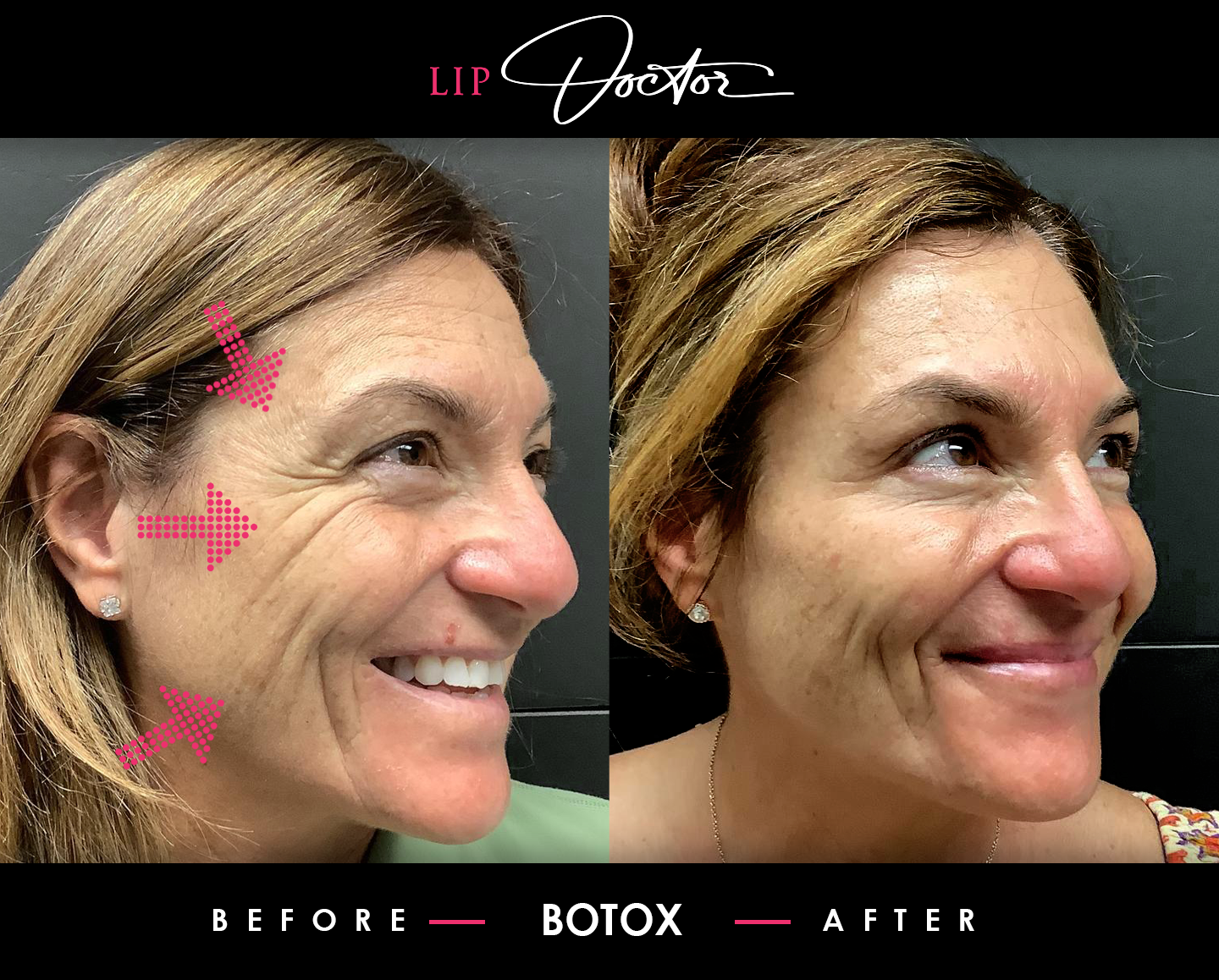  ALT Text: Before and after photo showing the effectiveness of Botox® treatments at Lip Doctor in Mississauga and Oakville, demonstrating visible reduction of forehead wrinkles and crow's feet.