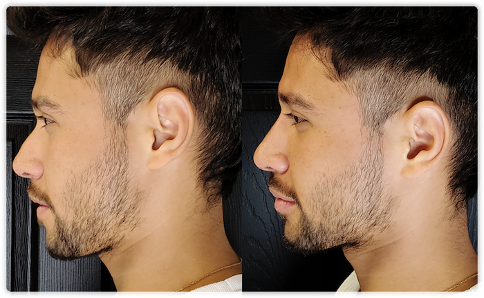 Before and after image of a young man's non-surgical nose job, highlighting significant enhancement and profile improvement at Lip Doctor.