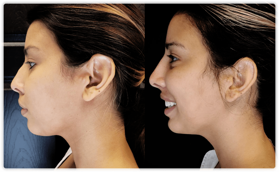 Before and after comparison of a non-surgical nose job at Lip Doctor, illustrating refined nasal contours and improved symmetry without surgery in Mississauga and Oakville