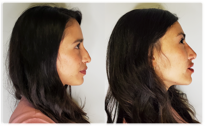 Before and after photo of a young woman's non-surgical nose job showcasing remarkable refinement and symmetry achieved at Lip Doctor.