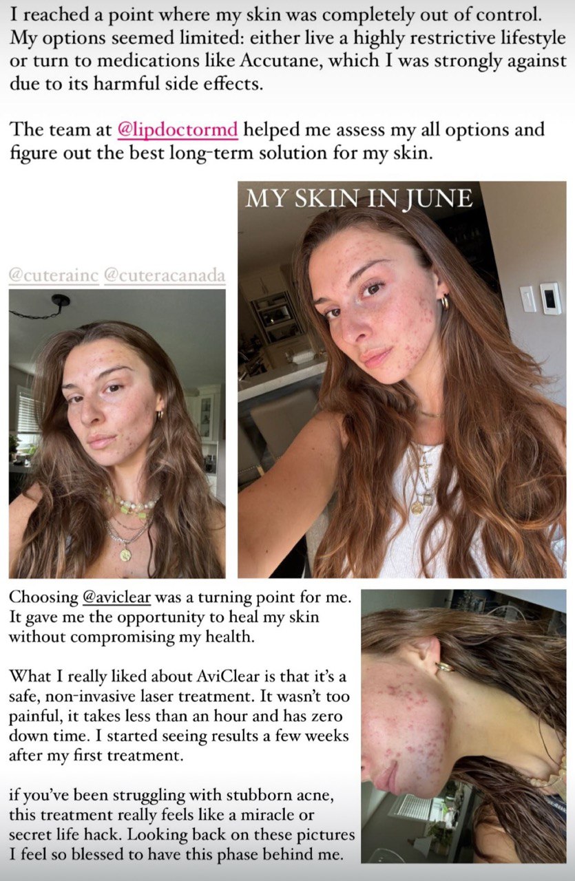 Laura shares her AviClear success story on Instagram after completing her acne treatment journey at Lip Doctor Mississauga