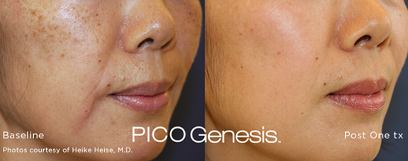 Before and after image of Pico Laser treatment showing significant skin improvement, targeting pigmentation and sun damage with clearer and more radiant results