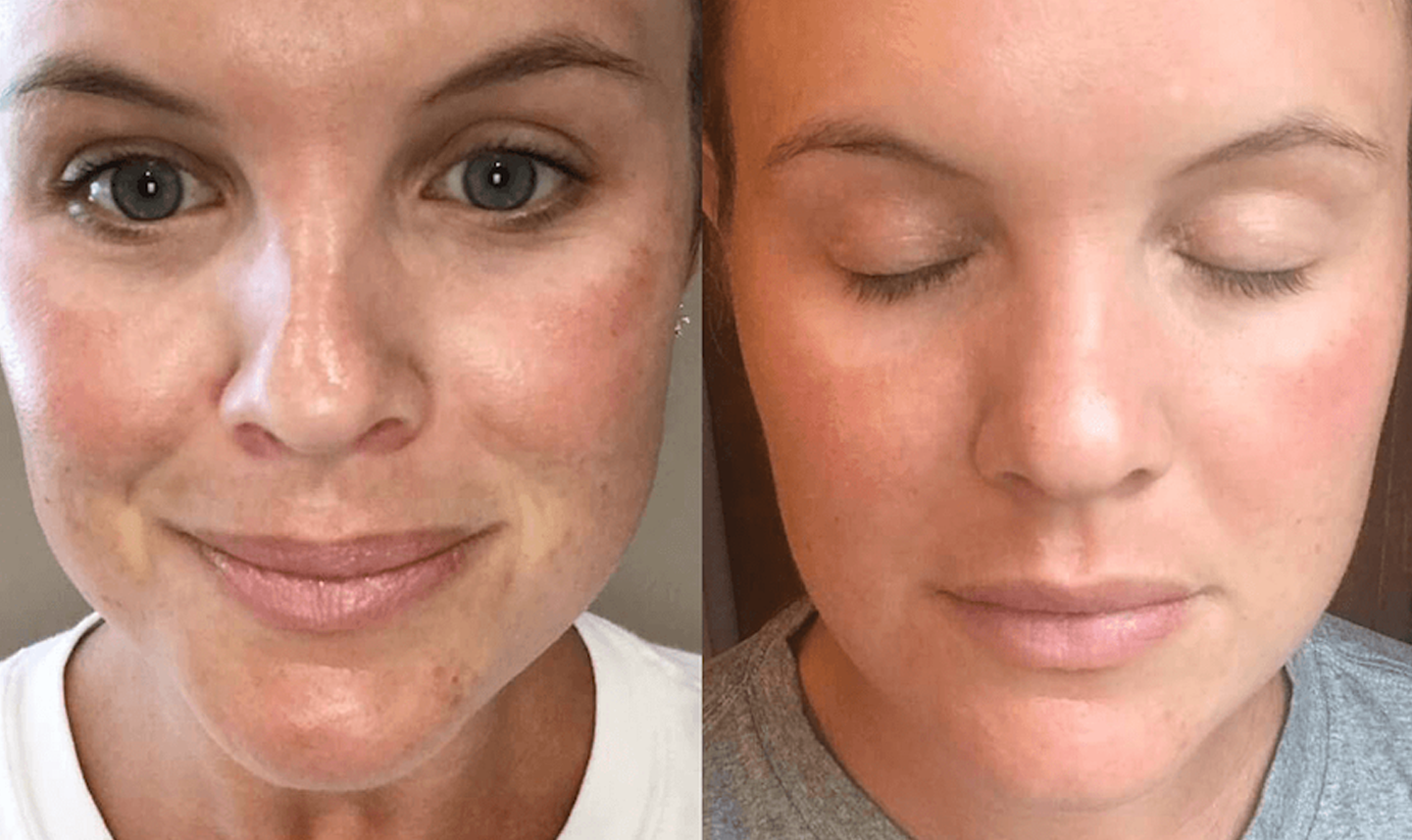 Before and after results of PRP facial rejuvenation treatment, showcasing improved skin texture and reduced fine lines.