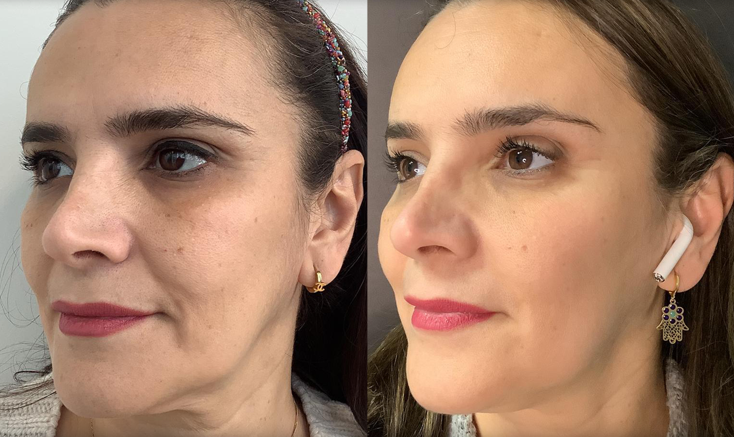 Before and after images of a client who received a thread lift combined with Sculptra to lift and restore facial volume, achieving a tighter, smoother appearance at Lip Doctor, Mississauga and Oakville