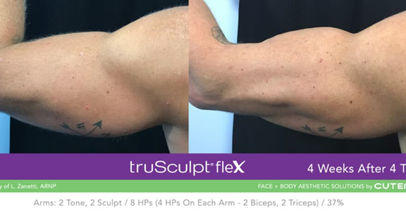 Before and after results showing significant fat reduction and body contouring on arms after TruSculpt treatment at Lip Doctor Mississauga and Oakville