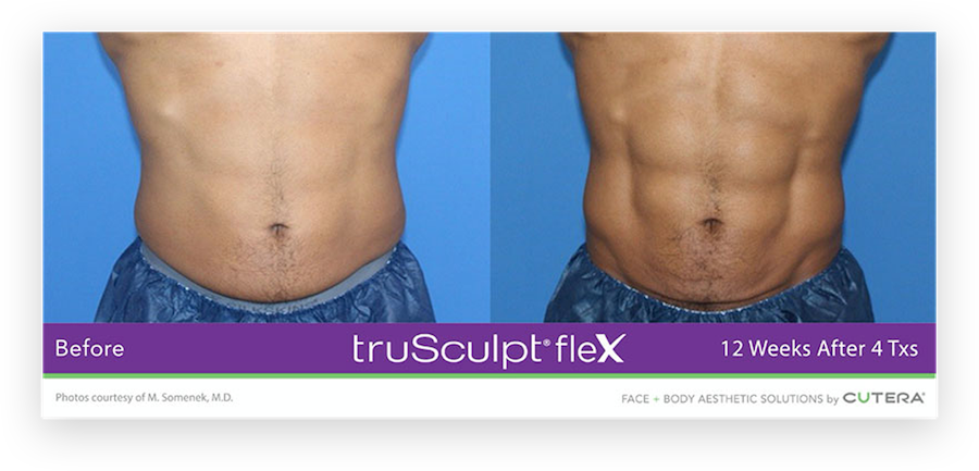 Before and after comparison of a TruFlex patient showcasing dramatic core strengthening and definition achieved