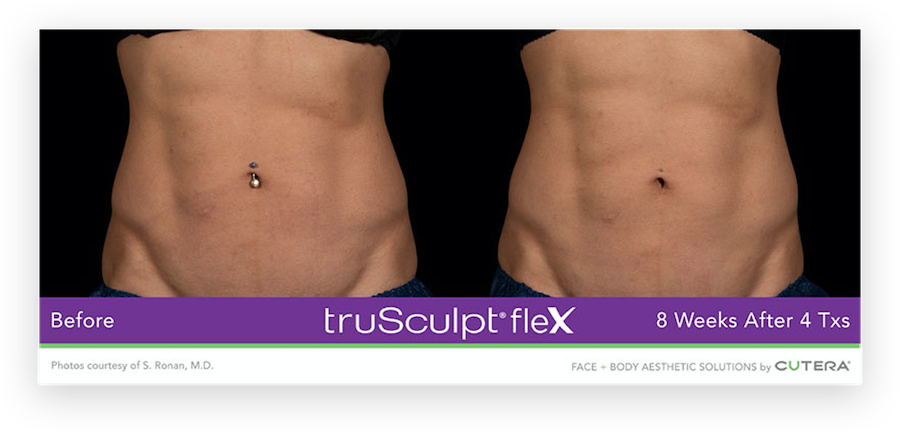 Before and after image showcasing dramatic results from TruFlex treatment 