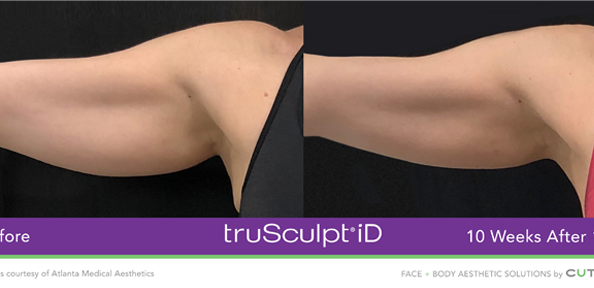 TruBody arm contouring treatment showcasing toned and sculpted arms after non-invasive fat reduction and muscle enhancement at Lip Doctor.