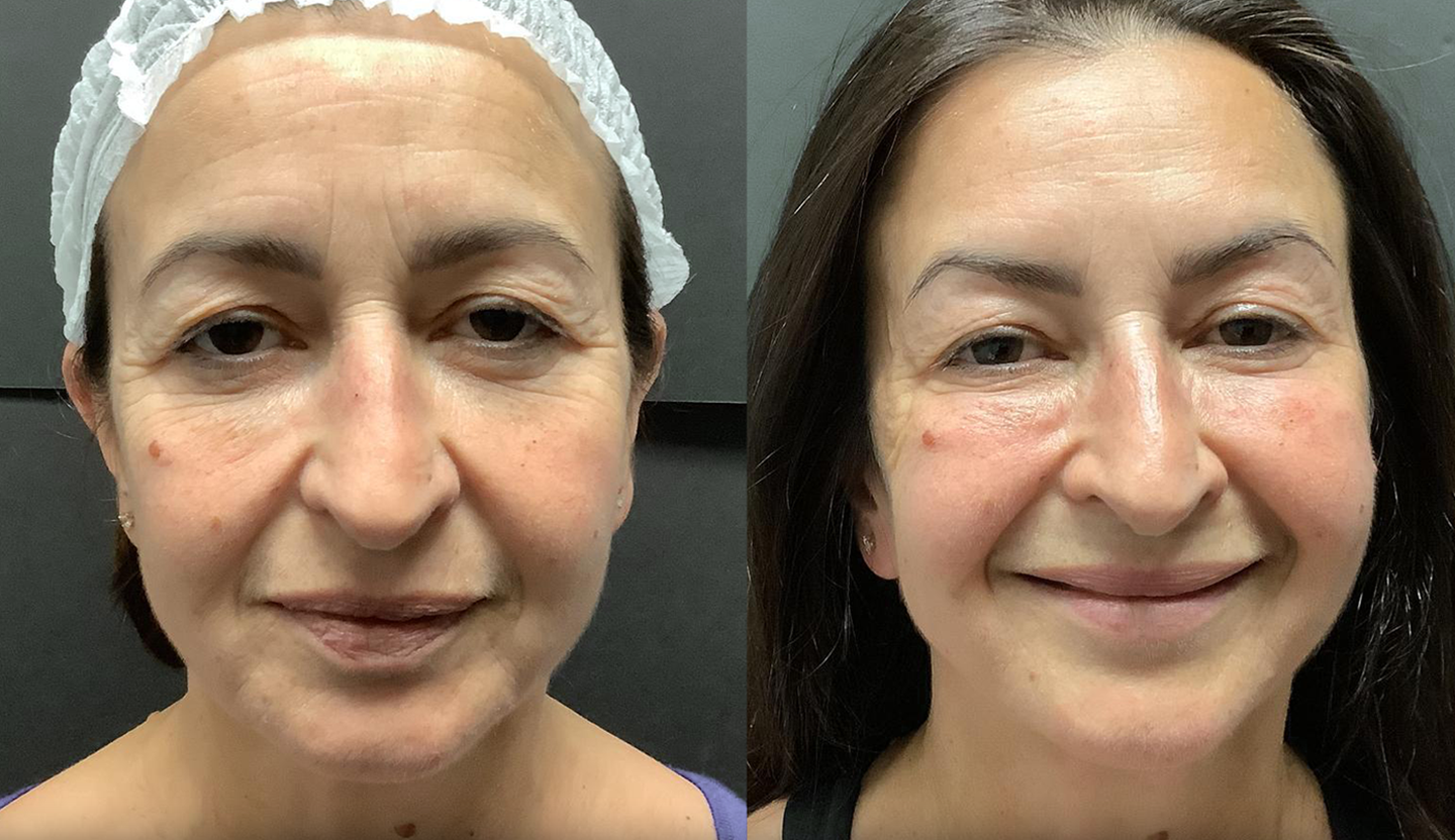 Fractora treatment for wrinkle reduction and anti-aging benefits, available in Mississauga and Oakville.