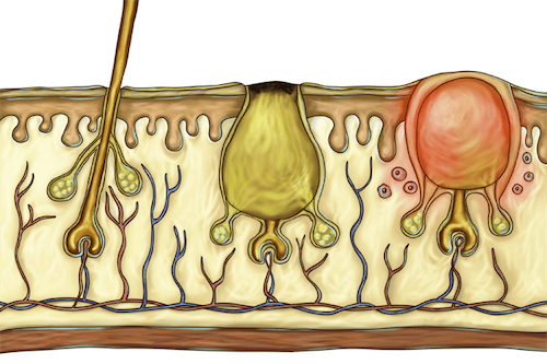 Acne Myths