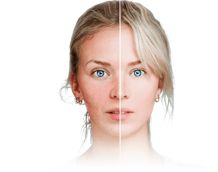 Acne Sings and Symptoms