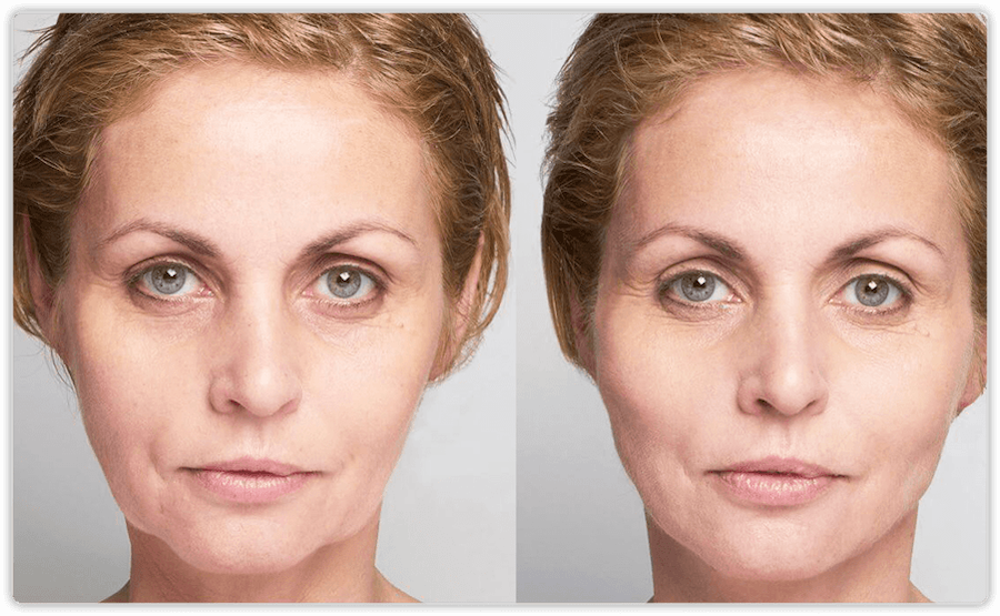 Thread Lift – Face Lift procedures in Toronto & Mississauga