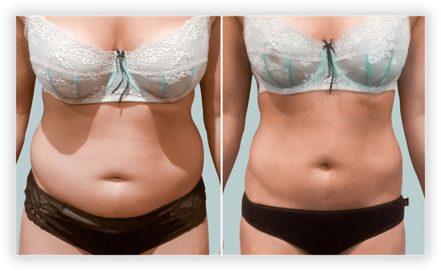 Le Beauty Concierge Body Contouring on X: Body contouring surgery
