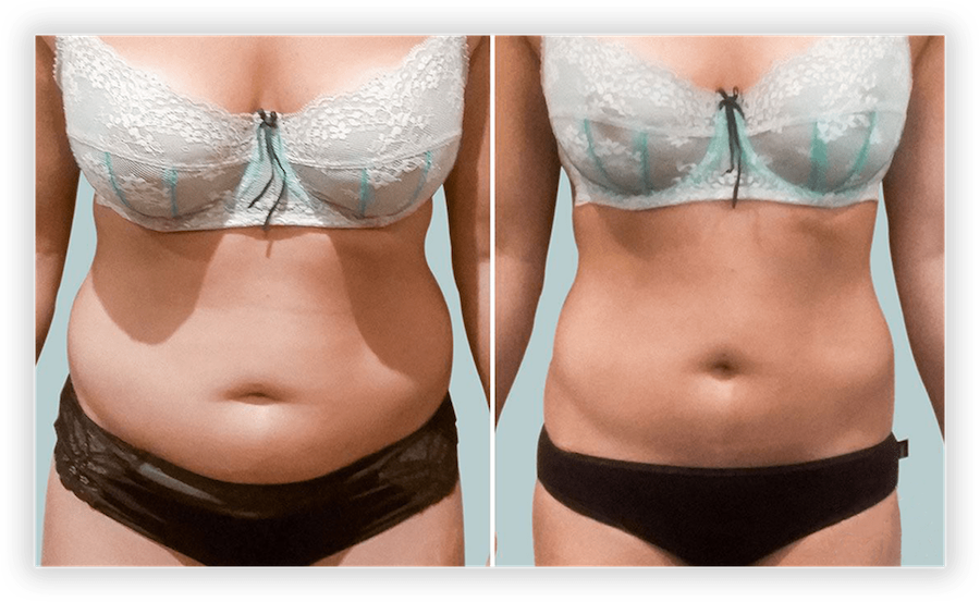 Non-Surgical Body Contouring Near Me Dearborn MI