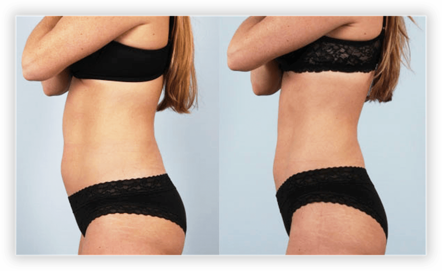 Body Contouring Before & After Pictures in Toronto & Mississauga