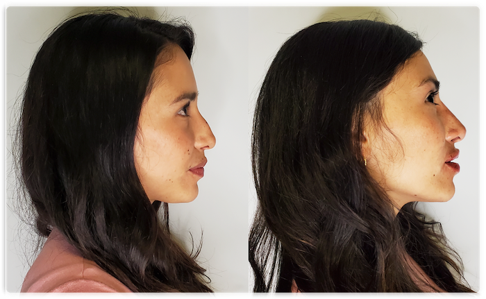 Facial Slimming Vancouver, BC  Non Surgical Jawline Treatment