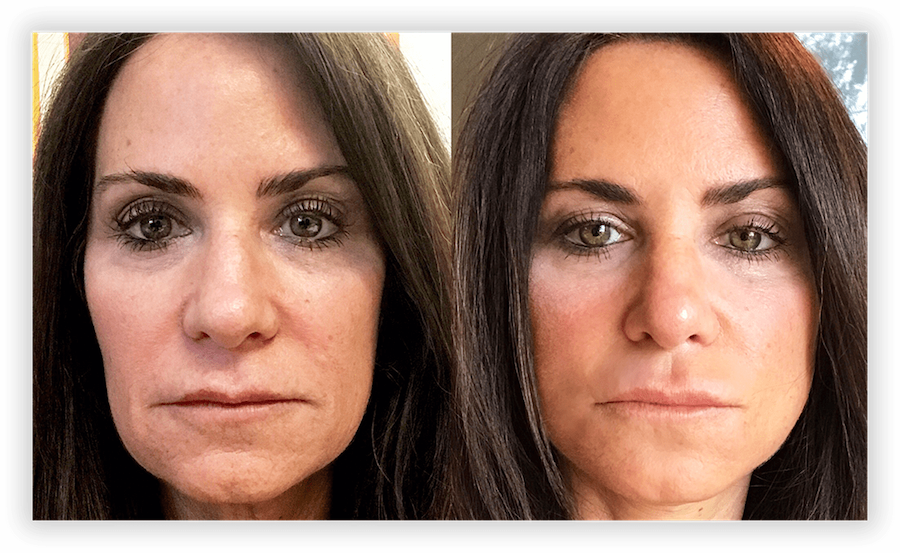 Skin Rejuvenation Before & After Pictures in Toronto & Mississauga