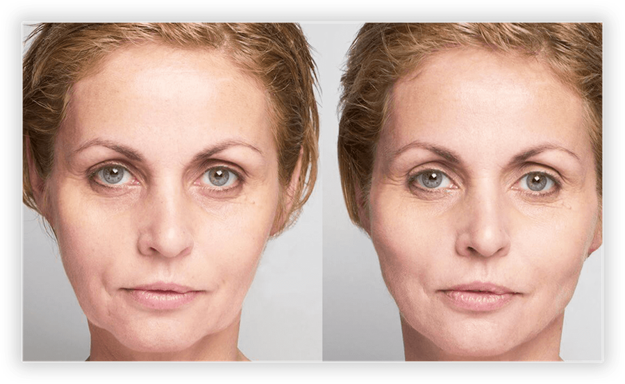 Before & After Non-Surgical Cosmetic Treatments - Greater Toronto Area ...