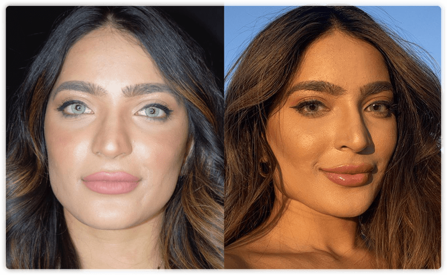 How to Get That Defined Look: Strong Cupid's Bow Lip Filler Techniques