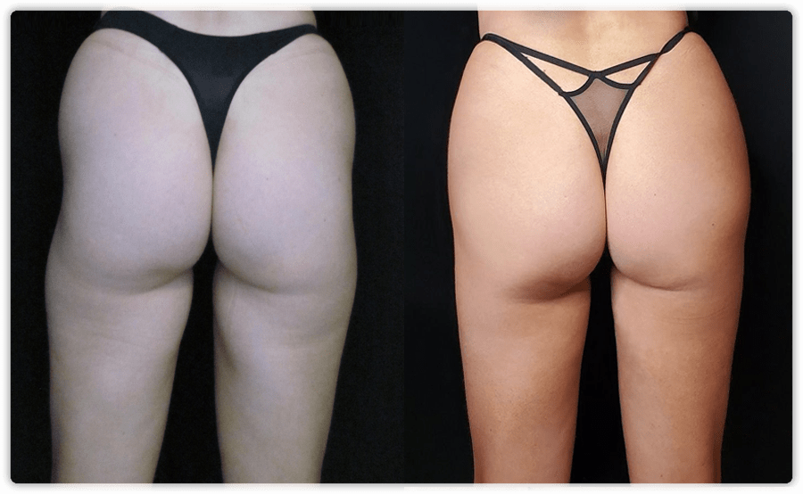 Body FX Non Surgical Body Contouring in St. Louis