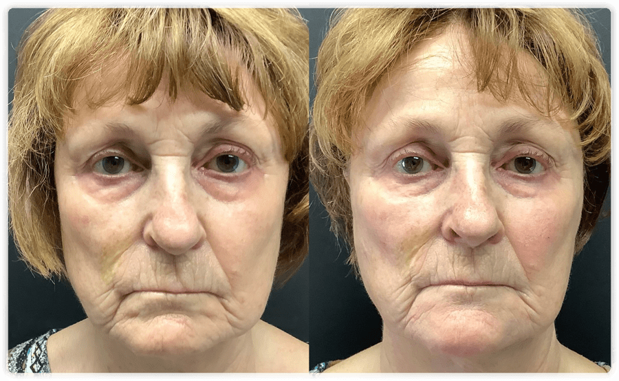 Non Surgical Face Lift Before And After