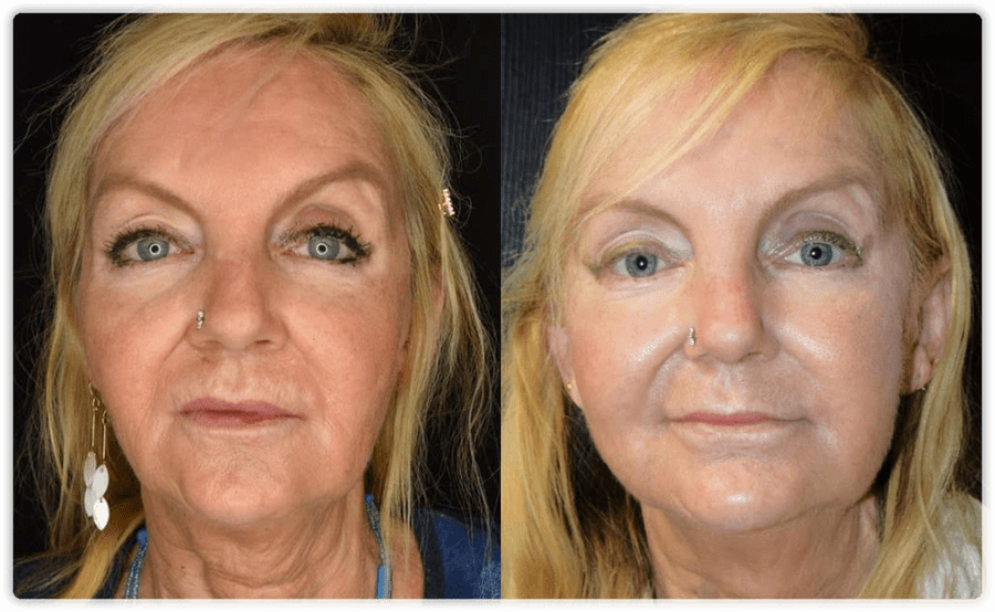 Eyebrow thread lift immediately after lifting the eyebrows. As collagen  builds over the next 90 days these results will continue to get…