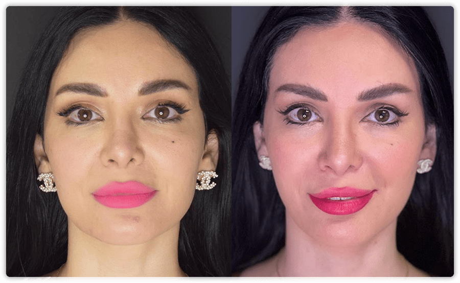 Thread Lifting: The Non-Surgical Face Lift